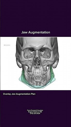 Custom Jaw Implants| Facial Implant Plan| Facial Plastic Surgery