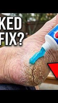 DIY Cracked Heel Treatment You Won't Believe Works