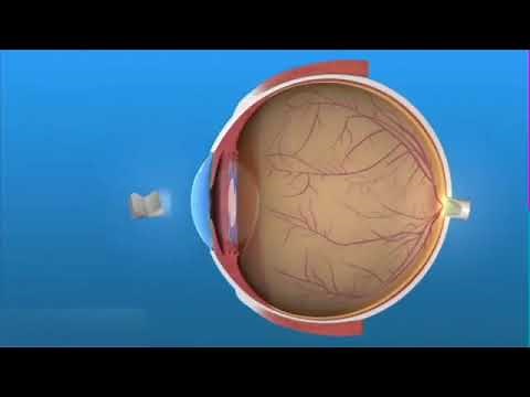 Implant de cataracte - Cristallin artificiel