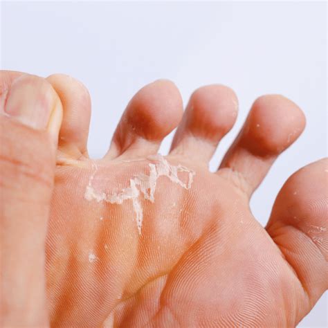 Keep your feet clean and dry