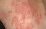 Heat Rash Itchy Skin Treatment Images