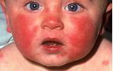 Pictures of Allergy Cough Toddler Treatment