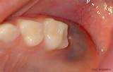 Images of Yellow Spot After Wisdom Teeth Removal