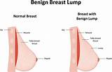 What Kind Of Doctor For Breast Lump Images
