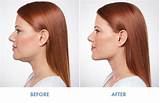 Kybella Injections Side Effects Pictures