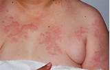 Hives Doctor Treatment Images