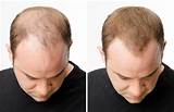 Pictures of Male Hair Loss Treatment