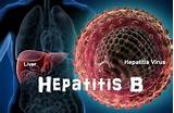 Pictures of Latest Treatment For Hepatitis B Virus