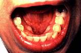 Floor Of Mouth Cancer Pictures