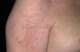 Photos of Eczema Skin Disease Treatment