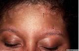Eczema Treatment African American Skin Pictures