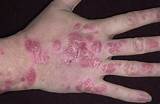 Hand Psoriasis Treatment