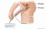 Images of Self Catheterization Female Supplies