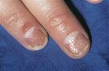 Pictures of Nail Pitting Treatment