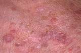 Photos of Lichen Simplex Chronicus Treatment Mayo Clinic