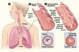 Home Remedies For Interstitial Lung Disease Pictures