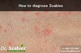 Images of Scabies Doctor