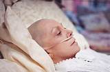 Images of Act Chemo Side Effects