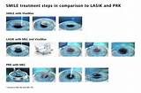 Pictures of Lasik Inflammation