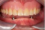 Pictures of False Teeth Bottom Plate