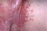 Pictures of Candida Groin Treatment