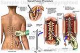 What Is The Recovery Time For Cervical Spinal Fusions Photos