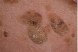 Benign Skin Cancer Treatment Images