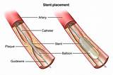 Photos of Stent Medical Definition