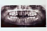 Photos of What Can I Take For Wisdom Tooth Pain
