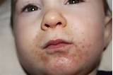 Images of Hand Foot And Mouth Diaper Rash Treatment