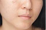 Images of Pimple And Dark Spot Removal