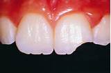Is A Broken Tooth A Dental Emergency Pictures