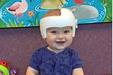 Photos of Cranial Helmets For Babies