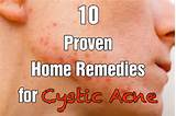 Photos of Home Remedies Cystic Acne
