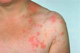 Images of Shingles Recovery Period