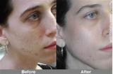 Best Natural Acne Scar Treatment