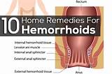 Pictures of Mayo Clinic Hemorrhoids