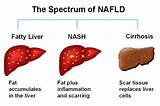 Images of What Is Fatty Liver Mayo Clinic