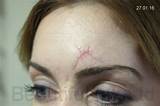 Pictures of Makeup For Surgical Scars