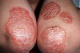 Images of Plaque Psoriasis Treatment Drugs