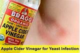 Images of Vinegar Home Remedies For Yeast Infection