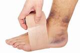 Swollen Ankle Sprain Treatment Images