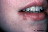 Photos of Herpes Where Can You Get It