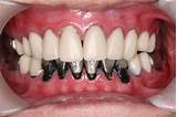 Silver Crowns Teeth Pictures