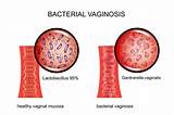 Bv Std Treatment