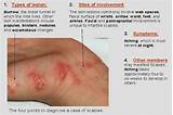 Images of Most Effective Scabies Treatment