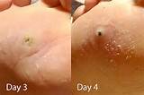 Do Home Remedies For Mole Removal Work Pictures