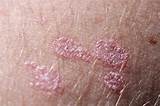 Silver Plaque Psoriasis Pictures