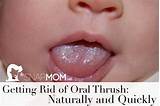 Images of Thrush In Newborns Home Remedies