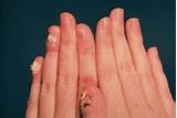 Photos of Infection Under Fingernail Home Remedies